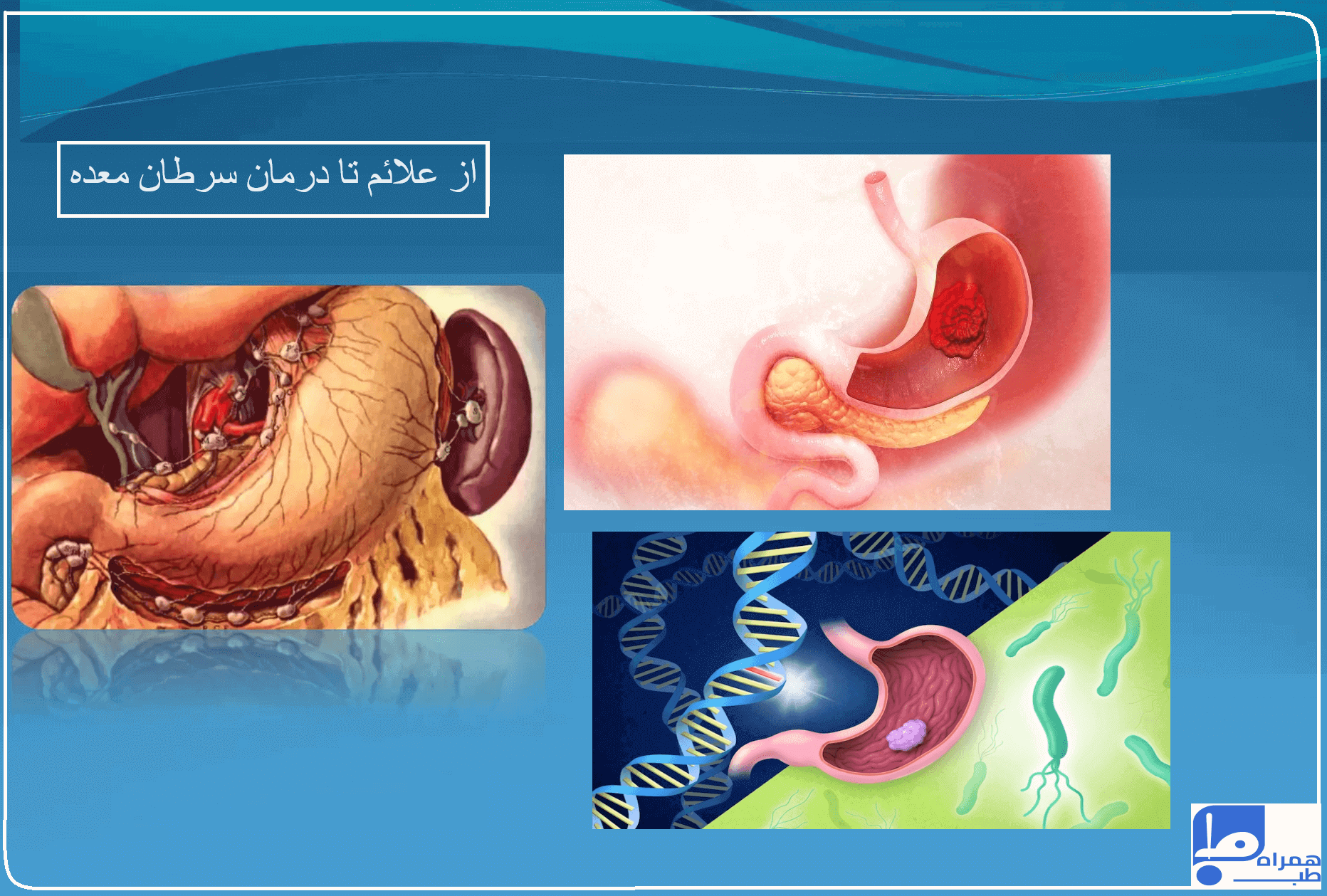 از کجا بفهمیم سرطان معده داریم؟